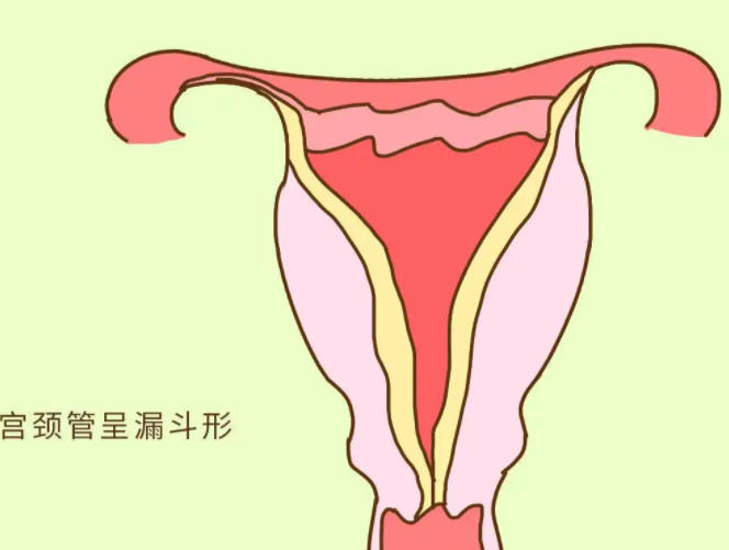 宁德助孕信息：宫颈息肉手术后会复发吗？(图1)
